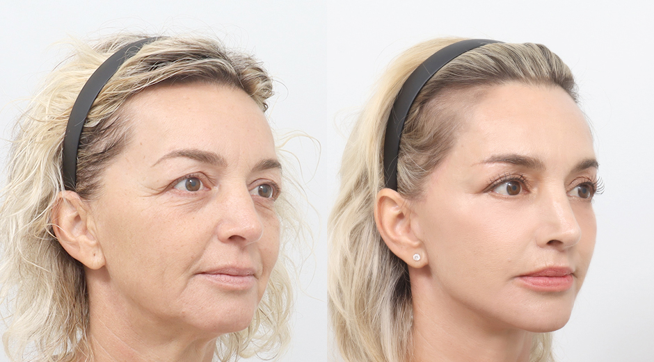 ab-plastic-surgery-anti-aging-beutrip